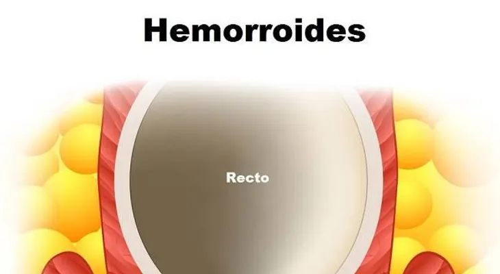 Remedios caseros para las almorranas