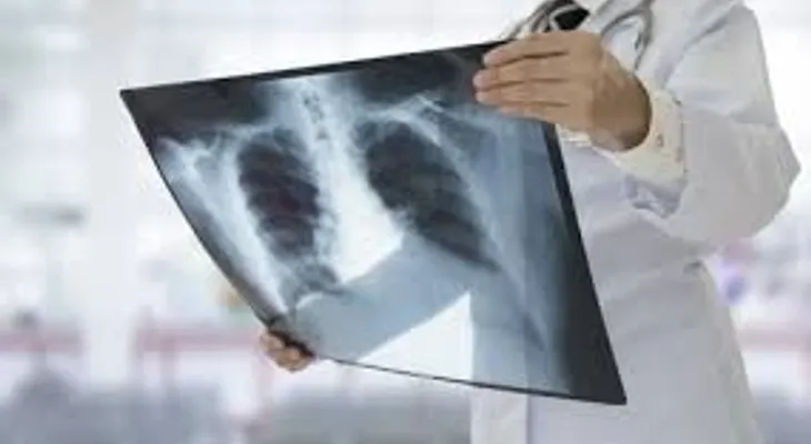  Cáncer de pulmón, en el punto de mira de los avances presentados en ASCO 