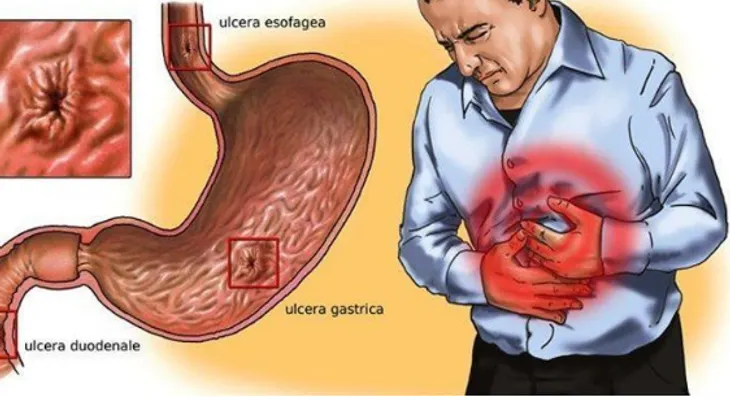 La gastritis: avena, miel y agua de arroz