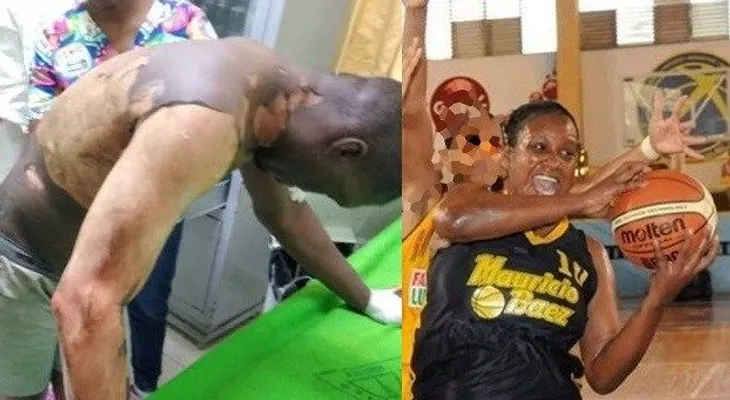 Exbasquebolista le prende fuego a su marido, por motivos de celos