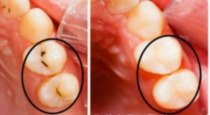 Conoce estos tips para tratar los huecos en los dientes sin ir al dentista 