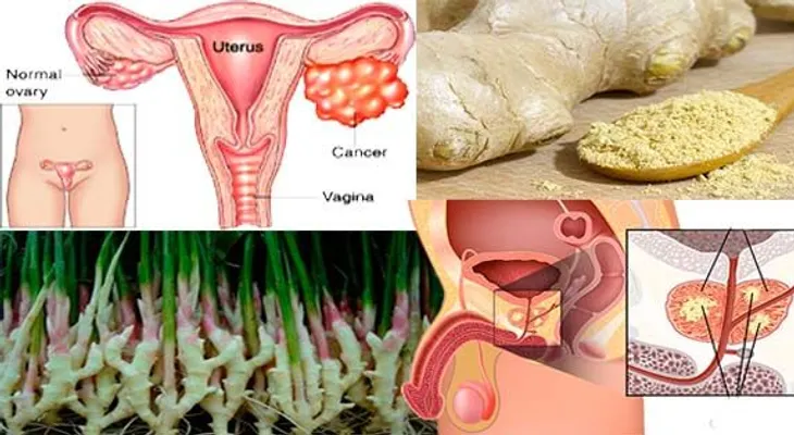 El jengibre funciona mejor que una quimioterapia: destruye tu CÁNCER de PRÓSTATA, de OVARIOS y de COLON 