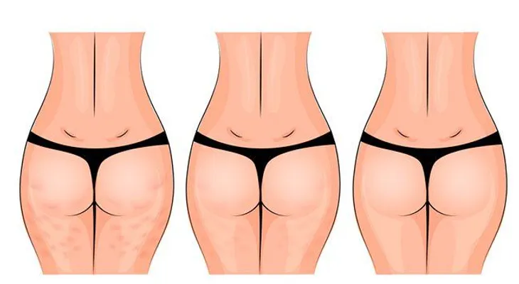 Crema casera para la flacidez de caderas y muslos