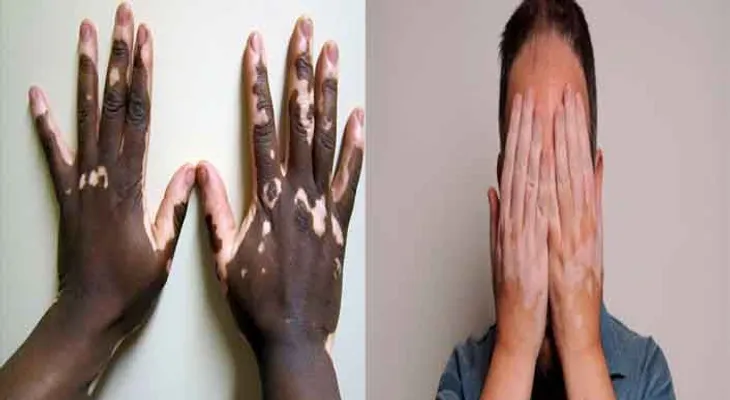 Millones en el Mundo celebran aparición nueva cura para el vitiligo