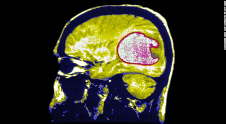 Número de tumores cerebrales se duplicó en Inglaterra y preocupa el uso de teléfonos móviles