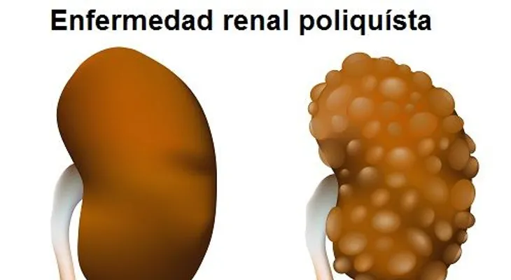 Causas de la insuficiencia renal y cómo tratarla naturalmente