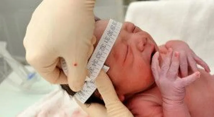 Nace en Maternidad de Los Mina el tercer bebé con microcefalia