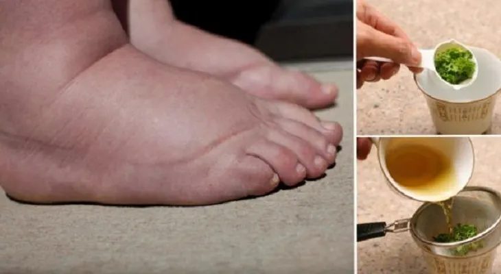 6 remedios que funcionan para deshinchar tobillos, pies y piernas