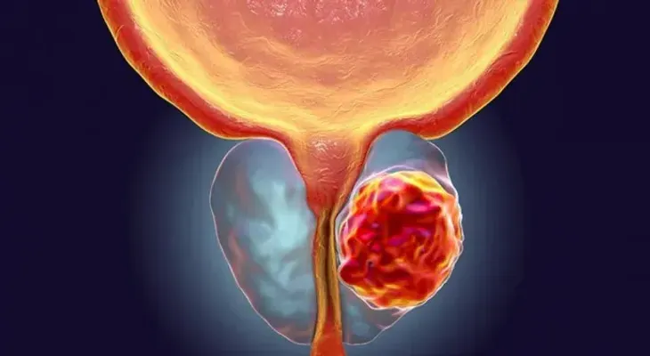 Médicos de AL experimentan con biomarcadores para atender cáncer de próstata