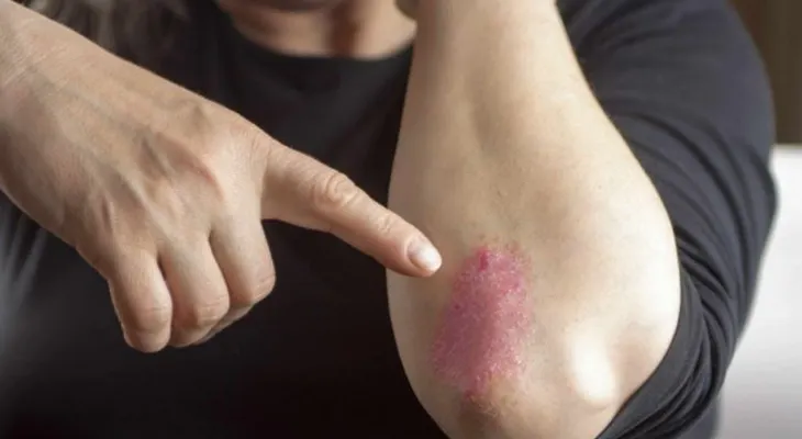 En la artritis psoriásica, cuanto antes empiece la terapia, mejor