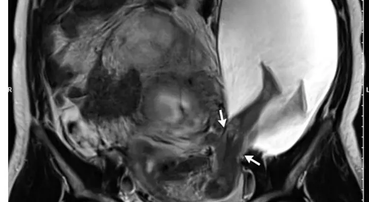 El extraño descubrimiento de un médico en el útero de una paciente: El niño está vivo y todavía patea