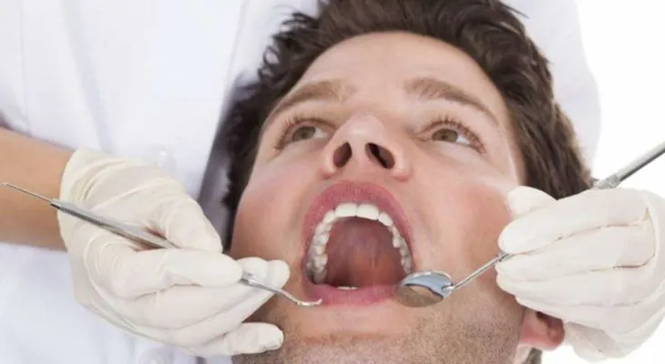 Sellador dental, ¿una solución para evitar caries?