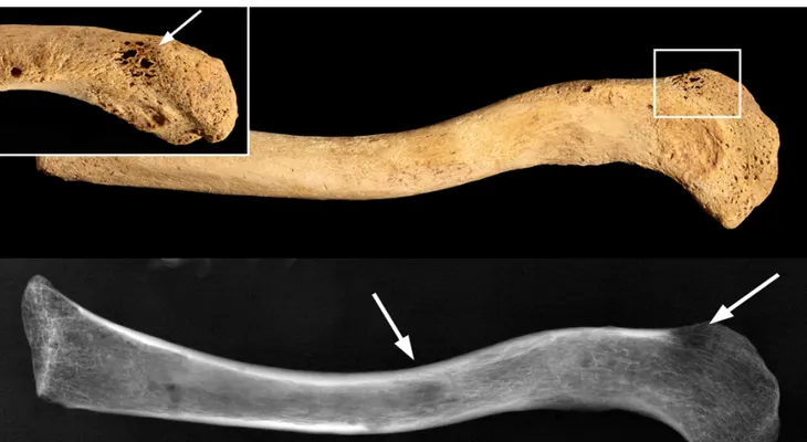 Hallan un cáncer de más de 3.000 años