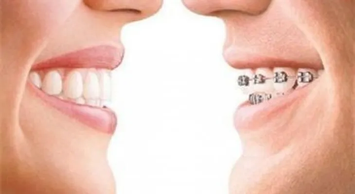 7 mitos y realidades sobre la ortodoncia
