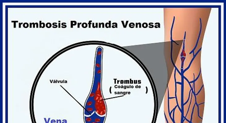 Coágulos en la sangre y signos inusuales que debes saber