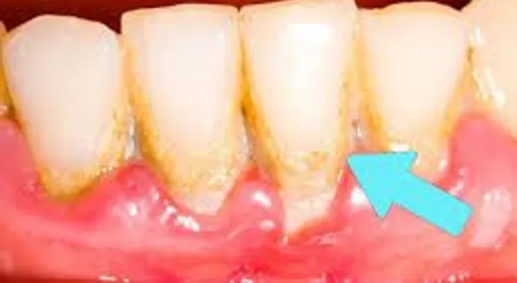 El sarro dental. Remedios para eliminarlo