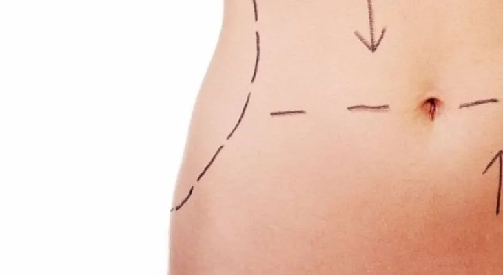 Seis preguntas típicas sobre la lipoaspiración
