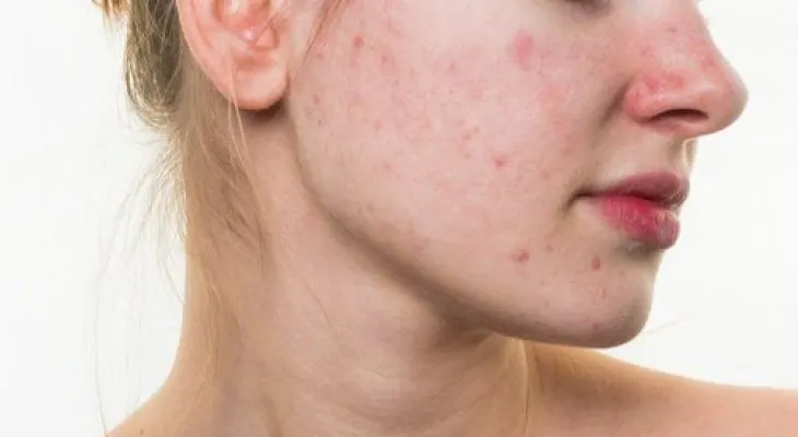 5 hábitos alimenticios que pueden destruir tu rostro