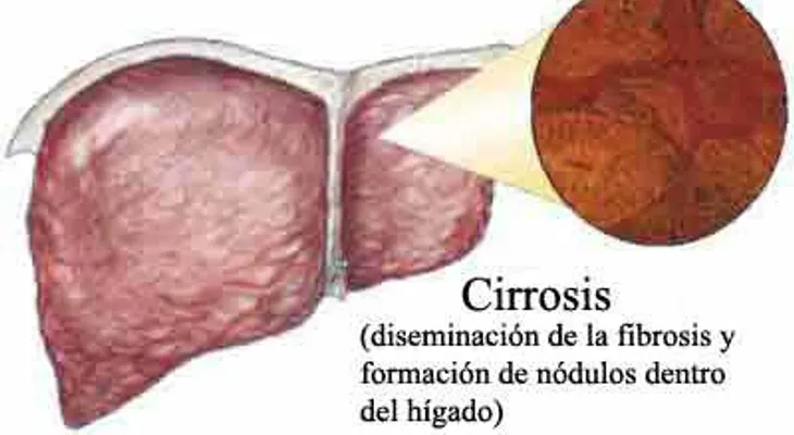 Tomar aceite de girasol o pescado puede causar cirrosis y cáncer de hígado