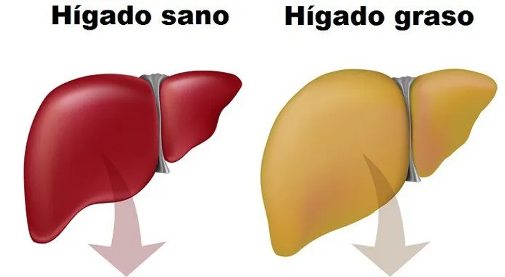 Hígado graso; hígado sano; síntomas, causas y tratamientos