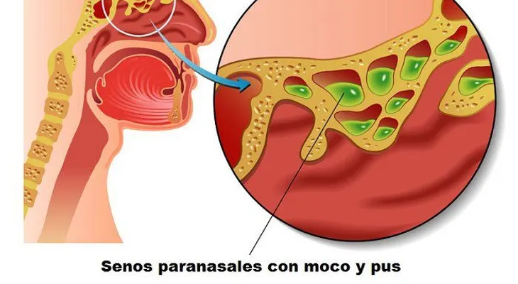 Cómo curar la infección sinusal con vinagre de sidra de manzana