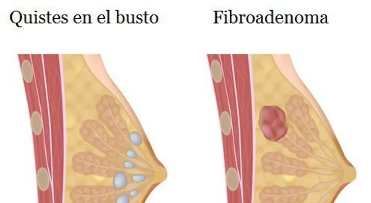 Qué son los bultos en los senos y signos de alarma