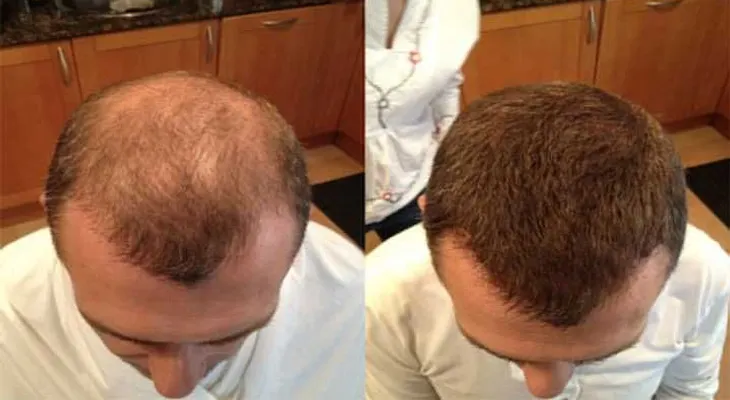 Adiós al peluquín y a los implantes. El pelo en polvo es la "solución" a la calvicie (VIDEO)