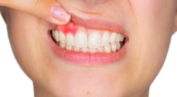 La gingivitis: causas, síntomas y tratamiento