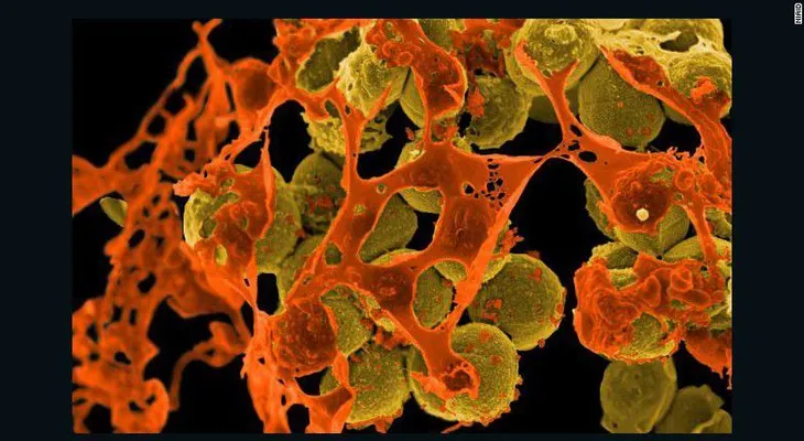 Hallan por primera vez en EE.UU. una superbacteria resistente a los antibióticos