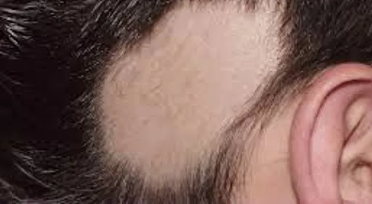 ¿Qué es la alopecia areata y quién puede desarrollar esta enfermedad?
