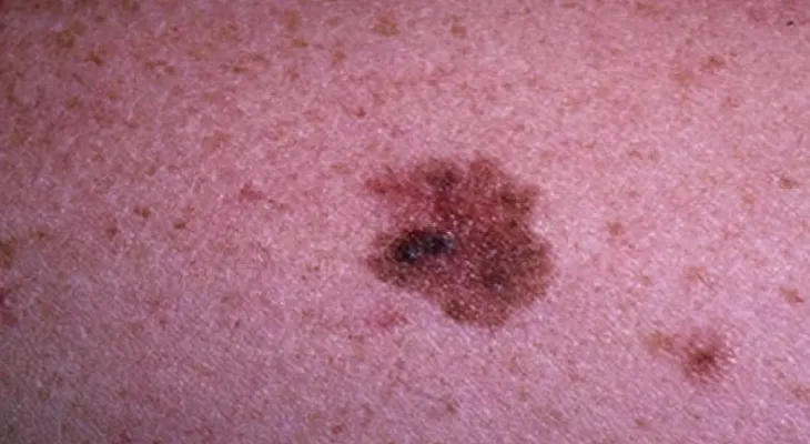 Pueden predecir respuesta a inmunoterapia en pacientes con melanoma