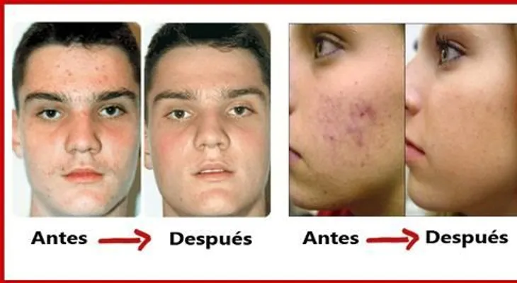 Cura para el acné de forma natural y para siempre