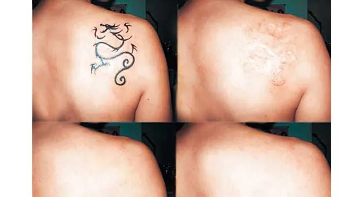¿Se pueden quitar los tatuajes sin lesionar la piel?