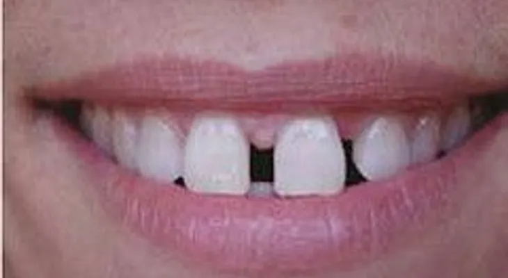Si tiene los dientes separados tiene que leer esto URGENTEMENTE