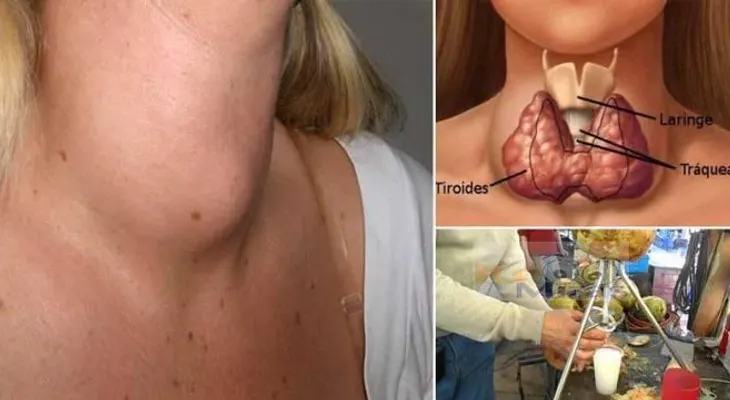 Estas son las toxinas que destruyen tu glándula tiroides y esta bebida saludable puede sanarla