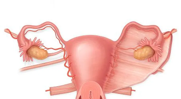 Los miomas uterinos: Todo lo que deberías saber y nadie te lo ha dicho