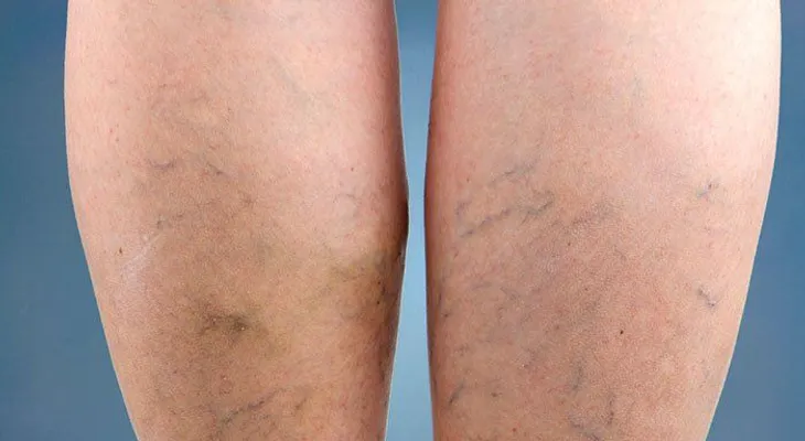 Elimina las varices con esta mezcla de aloe vera, zanahoria y vinagre