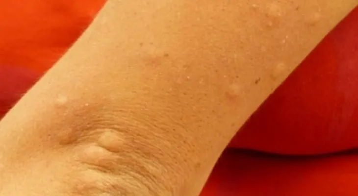 Formas naturales para vencer la urticaria o picazón
