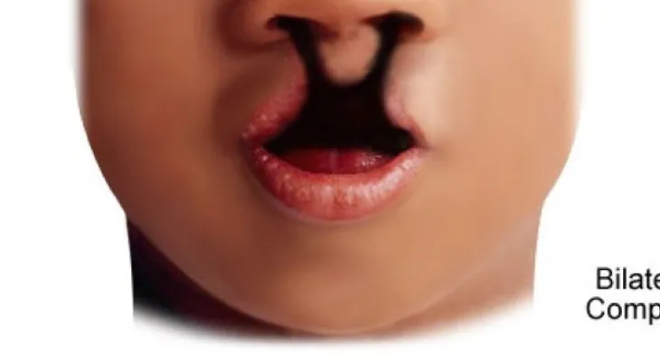 ¡Entérate! Operación del labio leporino alivia varios problemas
