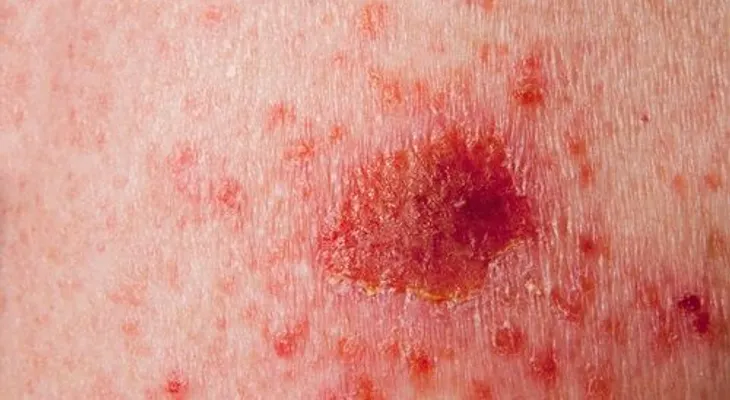 Tipos de cáncer de piel y cómo detectarlos