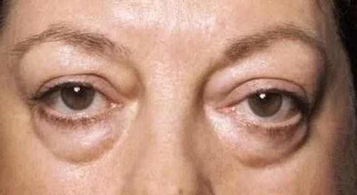¿Qué hacer cuando despiertas con los ojos hinchados?