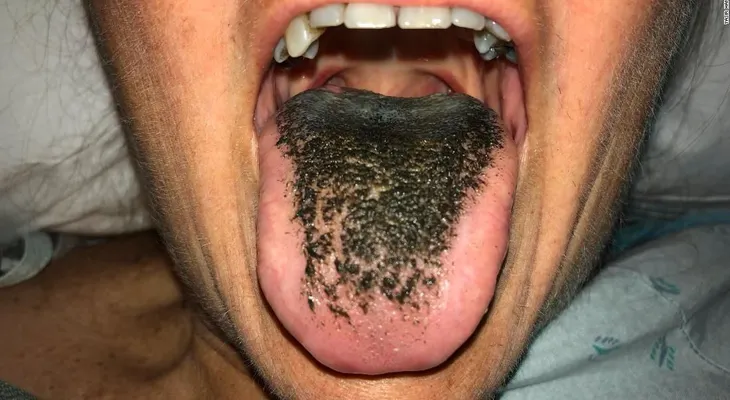¿En qué consiste la extraña condición de la lengua "peluda" negra?