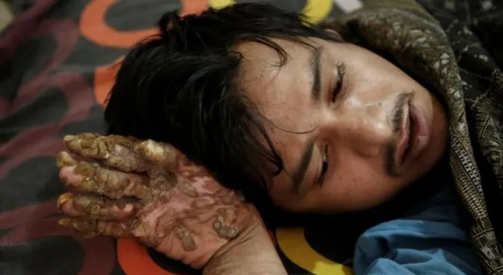 Piden cadena de oración mundial por "hombre árbol",  vuelve al hospital sin esperanza de ser curado