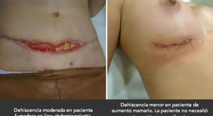 Estas son posibles complicaciones de la cirugía de liposucción