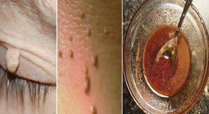 Elimina fácilmente cualquier fibroma o verruga de la piel en tan solo 1 semana sin dejar manchas!! funciona en todos los casos!!