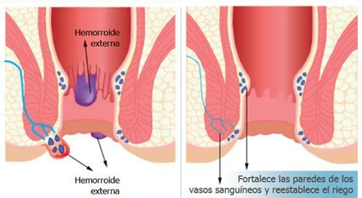 Luego de este remedio no tendrás que ir al quirófano a operar tus hemorroides
