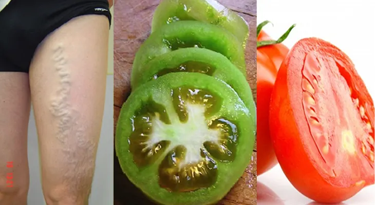 ASOMBROSO! Con la ayuda de un tomate se puede curar las venas varicosas