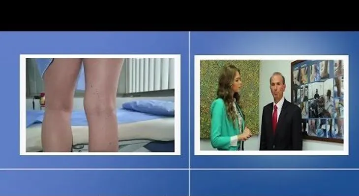Cómo eliminar ulceras varicosas y venas varices SIN CIRUGIA 