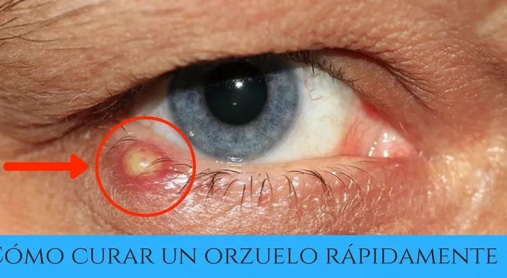 Cómo curar un orzuelo en el ojo? Causas y remedios