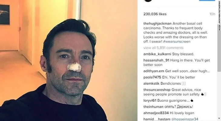 Hugh Jackman revela que se sometió a otro tratamiento contra el cáncer de piel